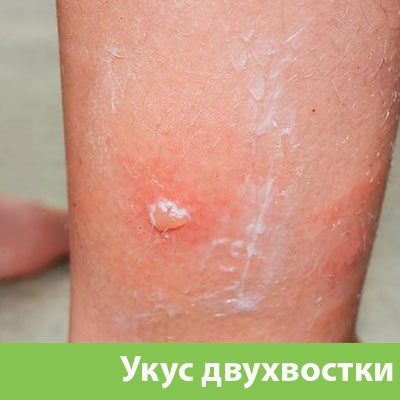 Укус двухвостки в Мариинске