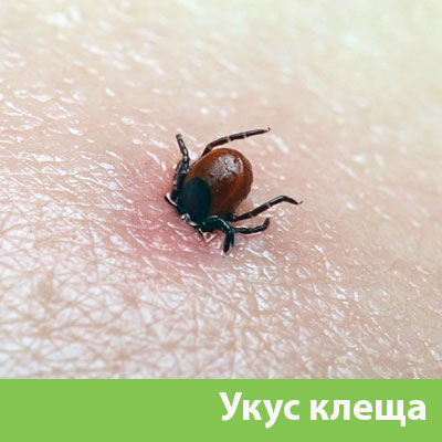 Укус клеща в Мариинске