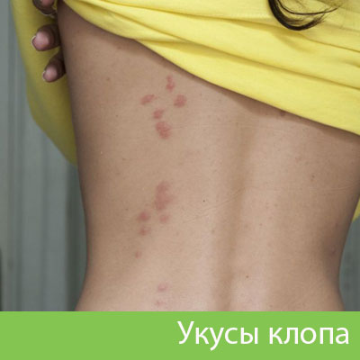 Профессиональное уничтожение клопов в Мариинске